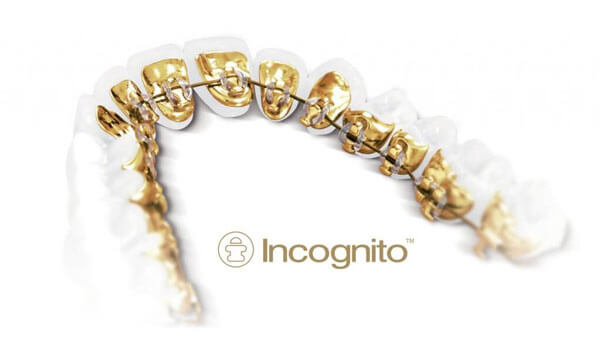 Incognito (tm) Braces