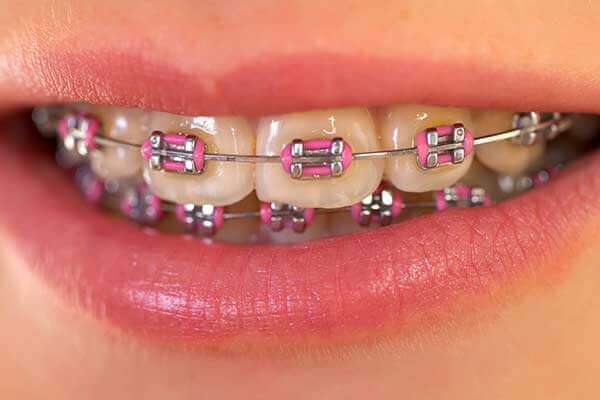 Traditional Metal Braces