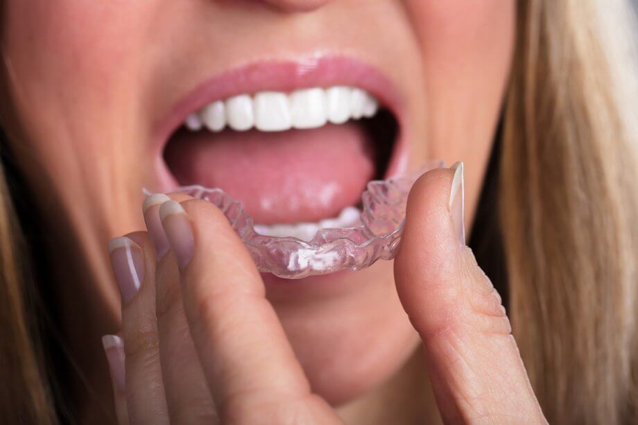 How Does Invisalign Work?