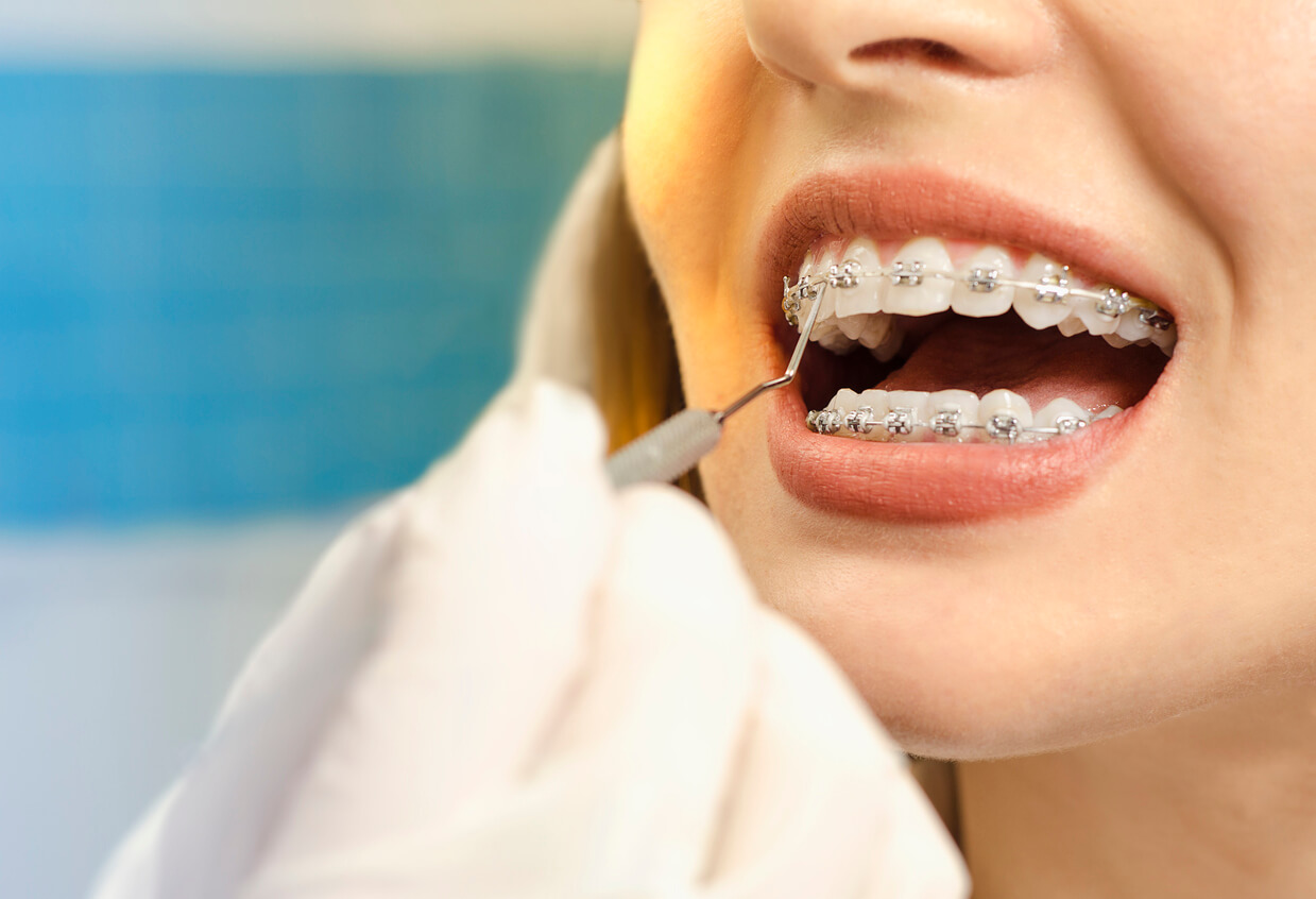 Getting Braces What You Should Know And What To Expect