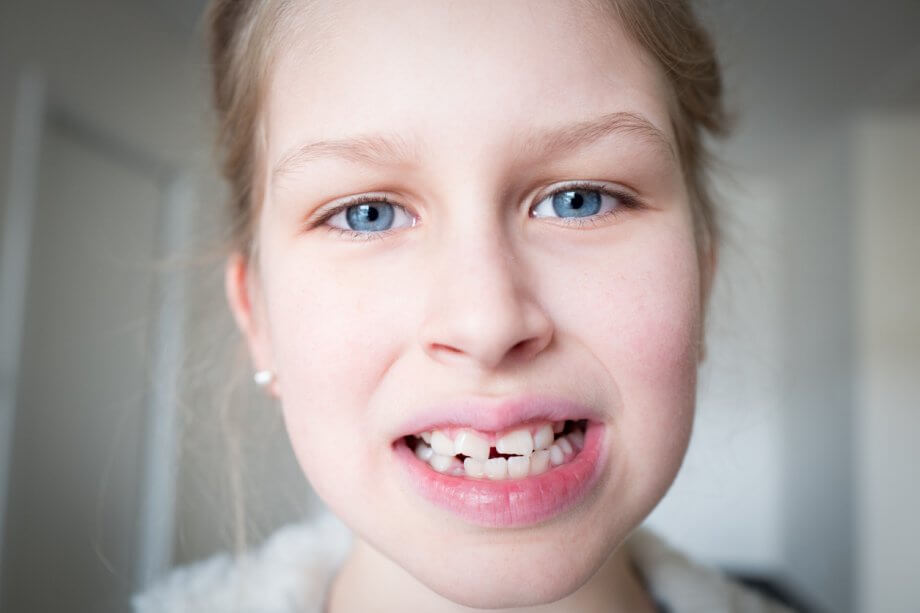 Young Girl Showing Missing Permanent Teeth