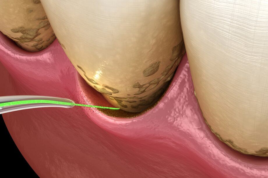 Signs Your Child Might Need a Frenectomy (and When to Talk to a Dentist)